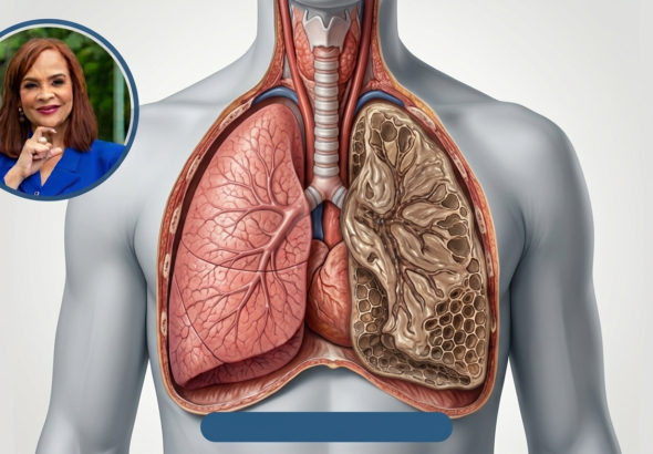 fibrosis pulmonar en RD