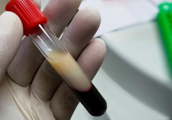 ¿Te suben los triglicéridos por la grasa que comes... o por el arroz, el pan y el jugo?