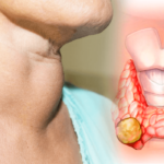 Cáncer de tiroides: aumentan los diagnósticos, pero mortalidad se mantiene baja en RD