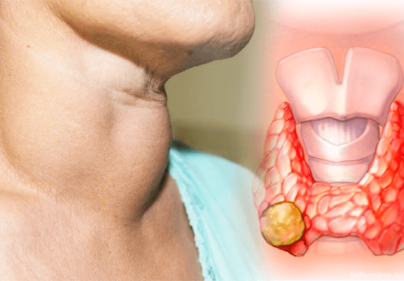 Cáncer de tiroides: aumentan los diagnósticos, pero mortalidad se mantiene baja en RD