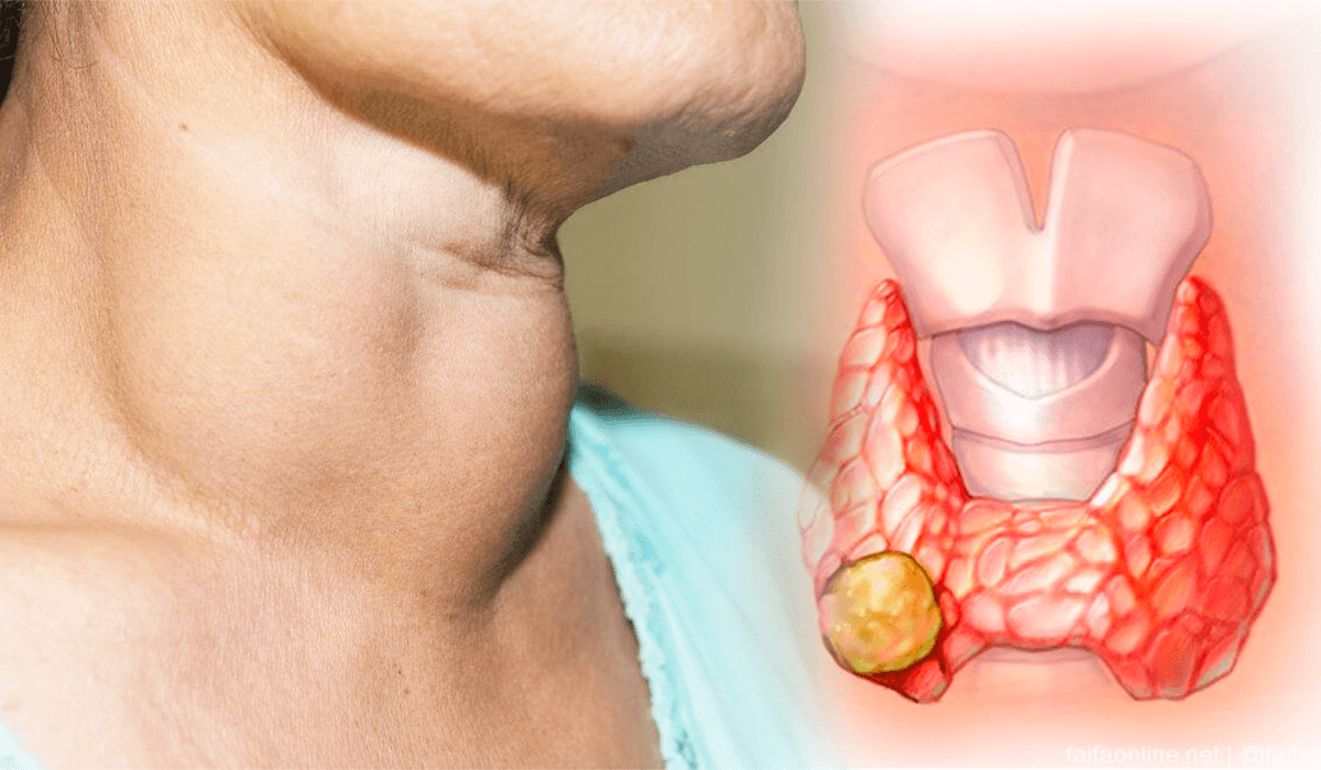 Cáncer de tiroides: aumentan los diagnósticos, pero mortalidad se mantiene baja en RD