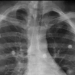 Nódulo pulmonar: qué significa el hallazgo que llevará al papa León XIV a cirugía