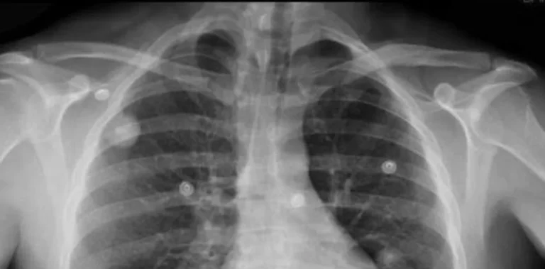 Nódulo pulmonar: qué significa el hallazgo que llevará al papa León XIV a cirugía
