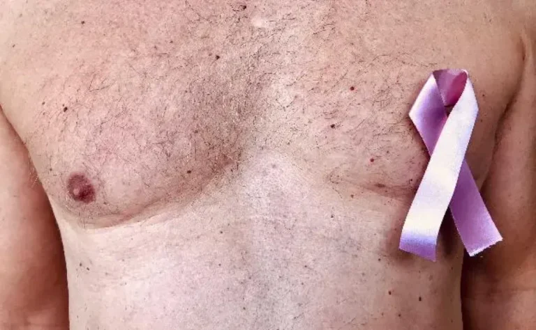 Cáncer de mama masculino: El riesgo aumenta con la edad, explica experta de Mayo Clinic
