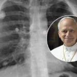 ¿Qué es un adenocarcinoma? El tipo de cáncer de pulmón diagnosticado al papa León XIV