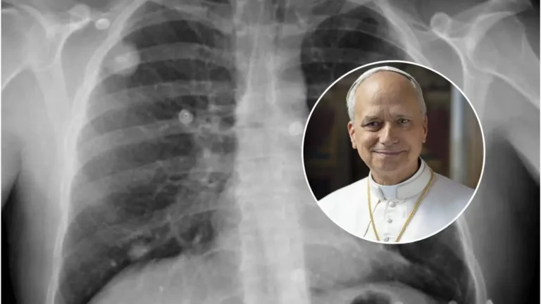 ¿Qué es un adenocarcinoma? El tipo de cáncer de pulmón diagnosticado al papa León XIV